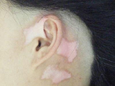 青少年刚得了白癜风能不能治疗好